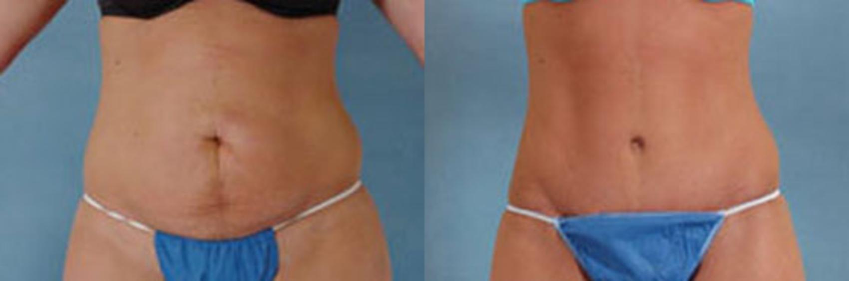 Before & After Tummy Tuck (Abdominoplasty) Case 121 View #1 View in Tallahassee, FL