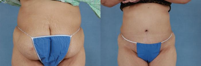 Before & After Tummy Tuck (Abdominoplasty) Case 122 View #1 View in Tallahassee, FL
