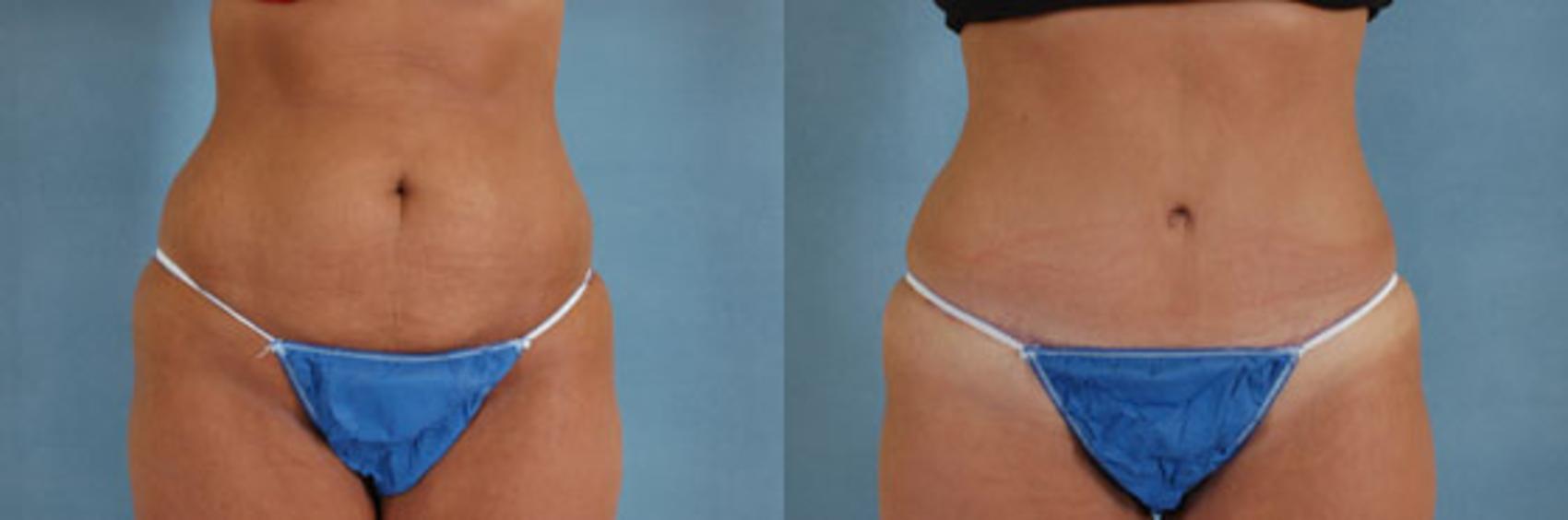 Before & After Tummy Tuck (Abdominoplasty) Case 123 View #1 View in Tallahassee, FL