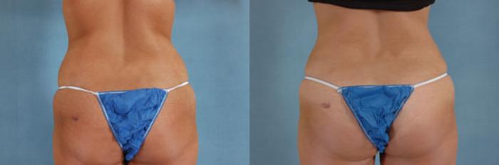 Before & After Tummy Tuck (Abdominoplasty) Case 123 View #3 View in Tallahassee, FL