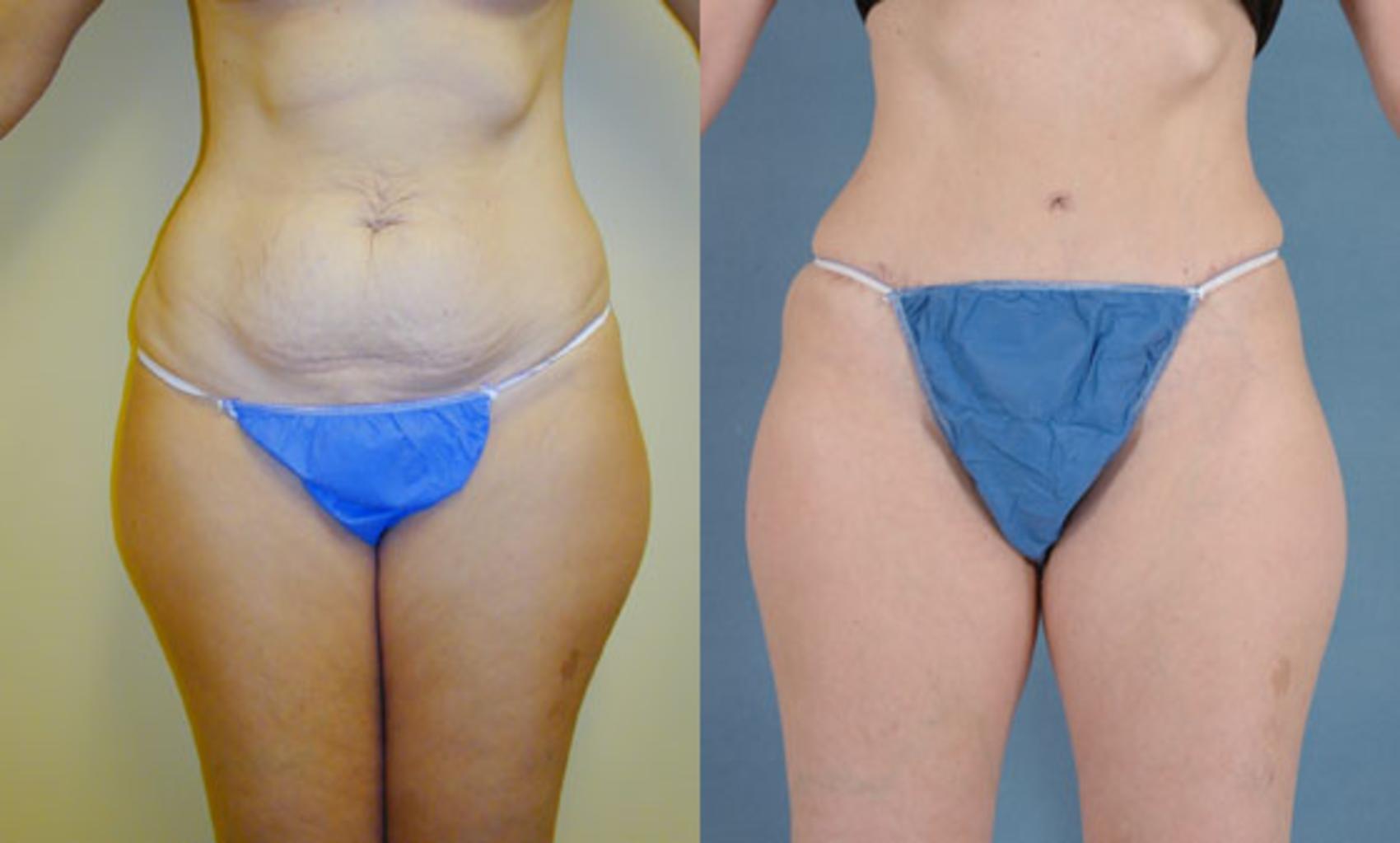 Before & After Tummy Tuck (Abdominoplasty) Case 124 View #1 View in Tallahassee, FL
