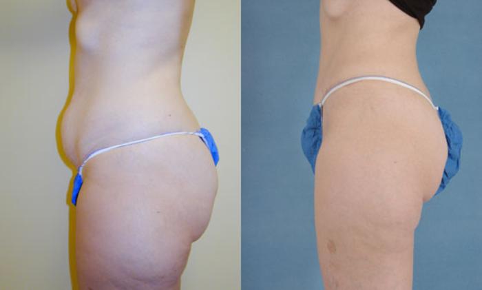 Before & After Tummy Tuck (Abdominoplasty) Case 124 View #2 View in Tallahassee, FL