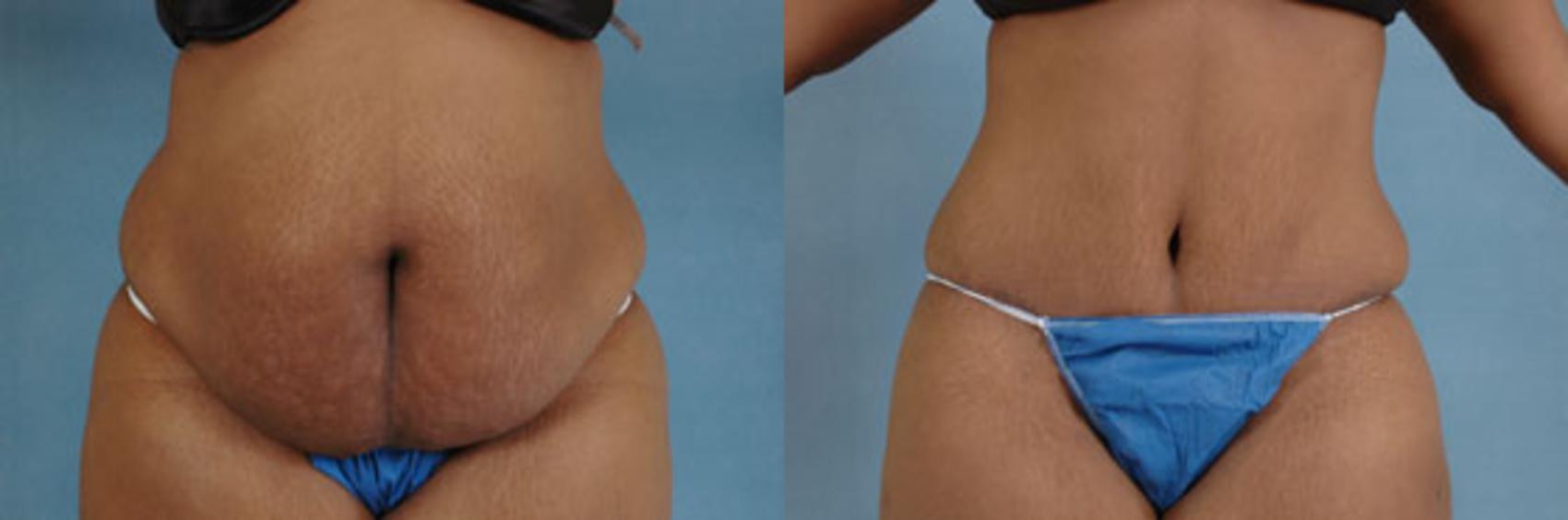 Before & After Tummy Tuck (Abdominoplasty) Case 125 View #1 View in Tallahassee, FL