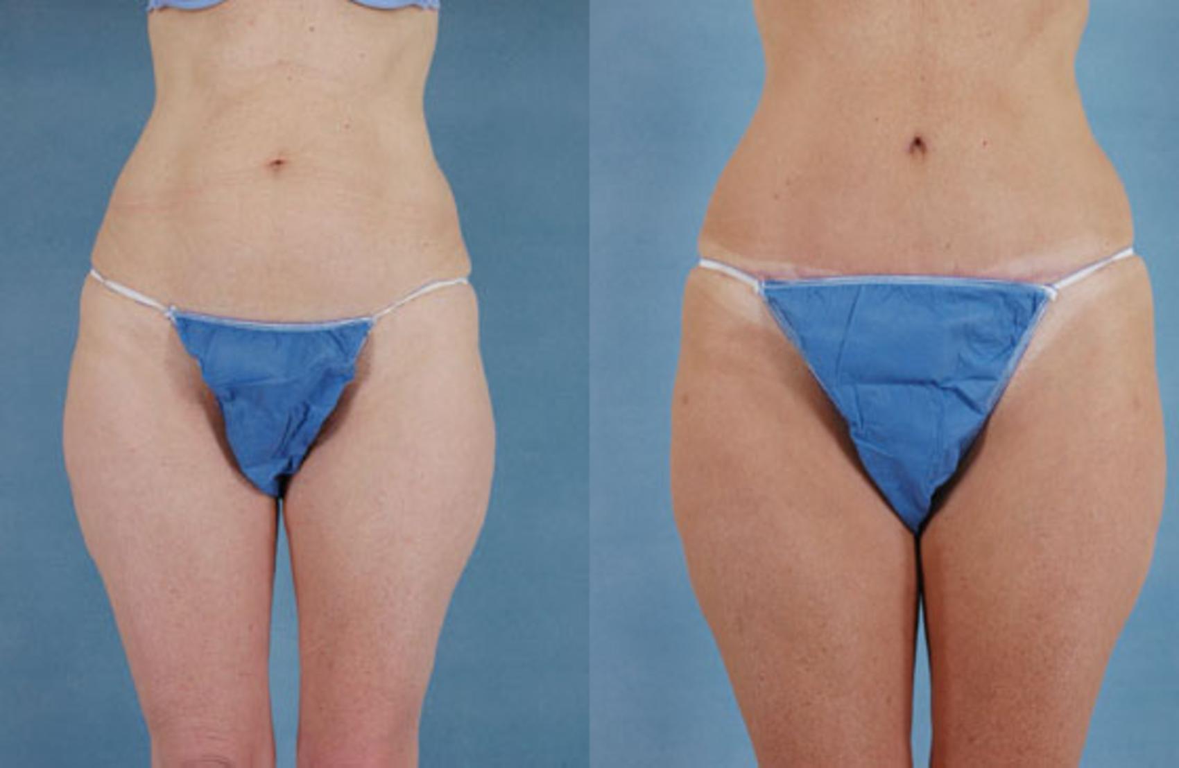 Before & After Tummy Tuck (Abdominoplasty) Case 126 View #1 View in Tallahassee, FL