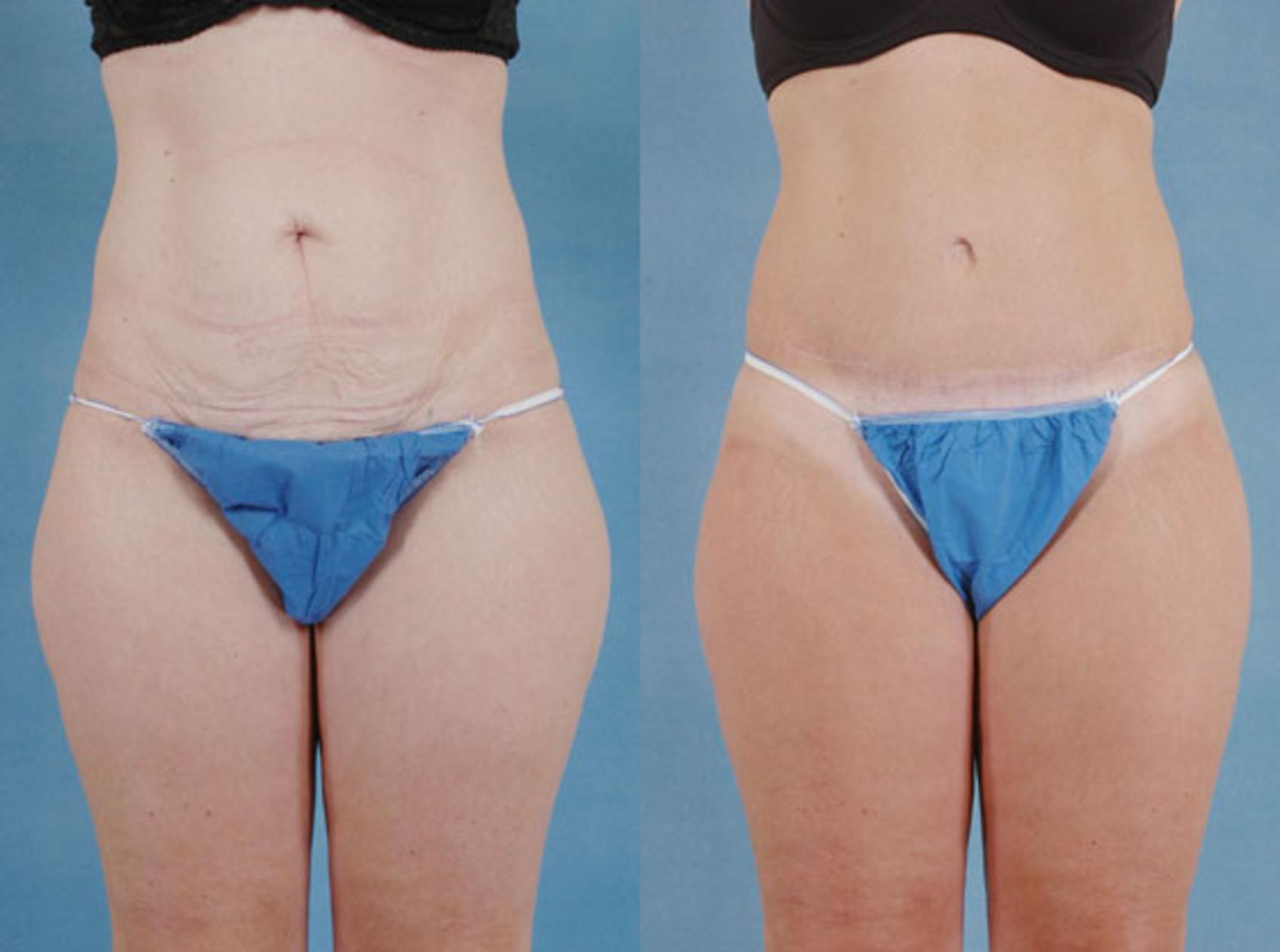 Before & After Tummy Tuck (Abdominoplasty) Case 127 View #1 View in Tallahassee, FL