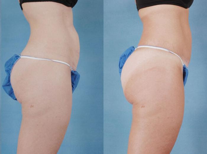 Before & After Tummy Tuck (Abdominoplasty) Case 127 View #2 View in Tallahassee, FL