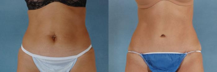 Before & After Tummy Tuck (Abdominoplasty) Case 128 View #1 View in Tallahassee, FL