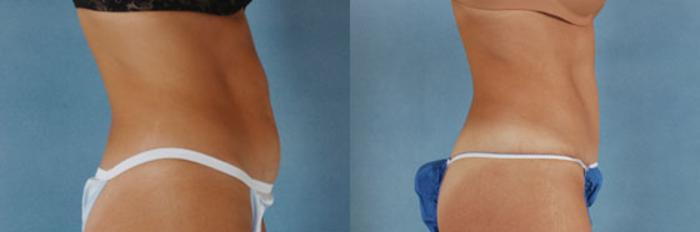 Before & After Tummy Tuck (Abdominoplasty) Case 128 View #2 View in Tallahassee, FL