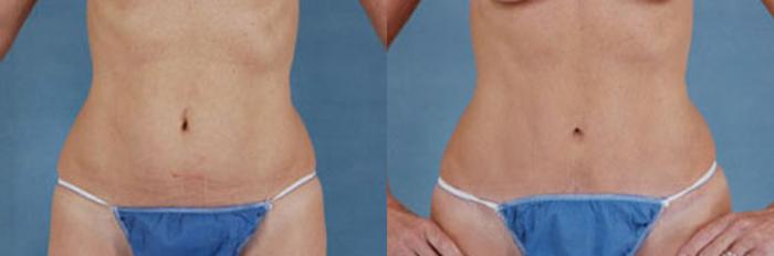 Before & After Tummy Tuck (Abdominoplasty) Case 129 View #1 View in Tallahassee, FL