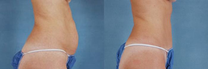 Before & After Tummy Tuck (Abdominoplasty) Case 129 View #2 View in Tallahassee, FL
