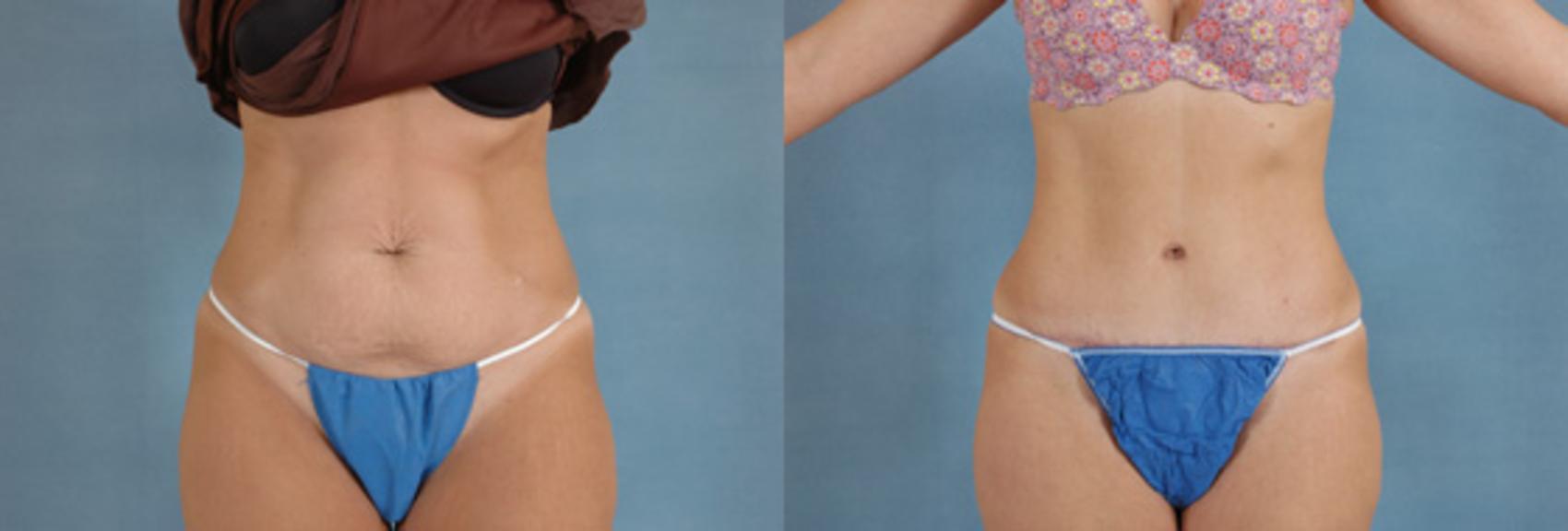 Before & After Tummy Tuck (Abdominoplasty) Case 130 View #1 View in Tallahassee, FL
