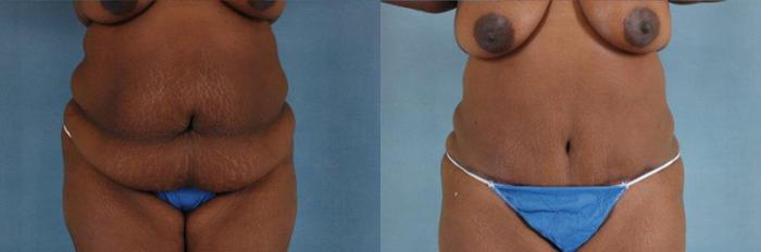 Before & After Tummy Tuck (Abdominoplasty) Case 131 View #1 View in Tallahassee, FL