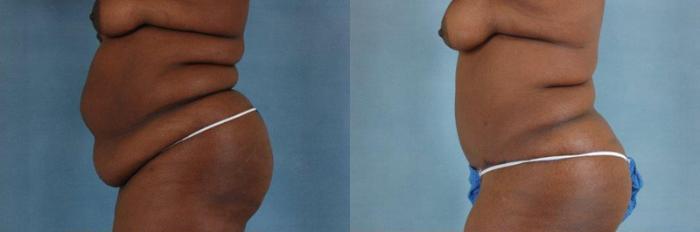 Before & After Tummy Tuck (Abdominoplasty) Case 131 View #2 View in Tallahassee, FL
