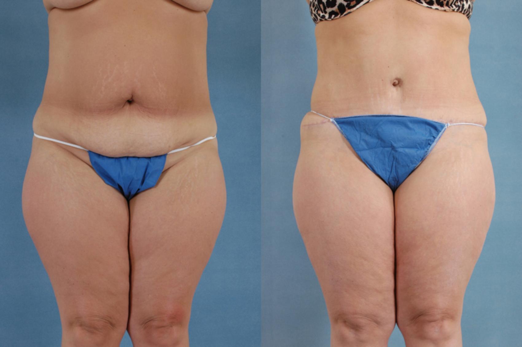 Before & After Tummy Tuck (Abdominoplasty) Case 133 View #1 View in Tallahassee, FL