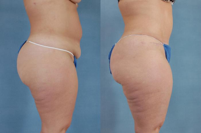 Before & After Tummy Tuck (Abdominoplasty) Case 133 View #2 View in Tallahassee, FL