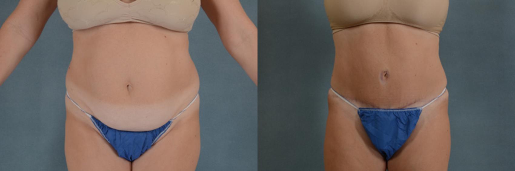 Before & After Tummy Tuck (Abdominoplasty) Case 134 View #1 View in Tallahassee, FL