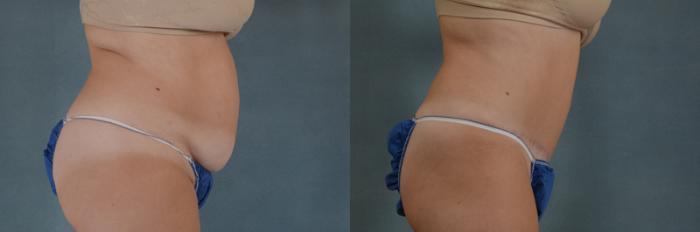 Before & After Tummy Tuck (Abdominoplasty) Case 134 View #2 View in Tallahassee, FL