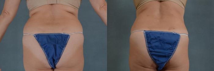 Before & After Tummy Tuck (Abdominoplasty) Case 134 View #3 View in Tallahassee, FL