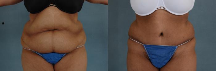 Before & After Tummy Tuck (Abdominoplasty) Case 135 View #1 View in Tallahassee, FL