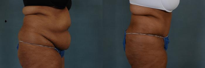 Before & After Tummy Tuck (Abdominoplasty) Case 135 View #2 View in Tallahassee, FL