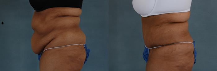 Before & After Tummy Tuck (Abdominoplasty) Case 135 View #3 View in Tallahassee, FL