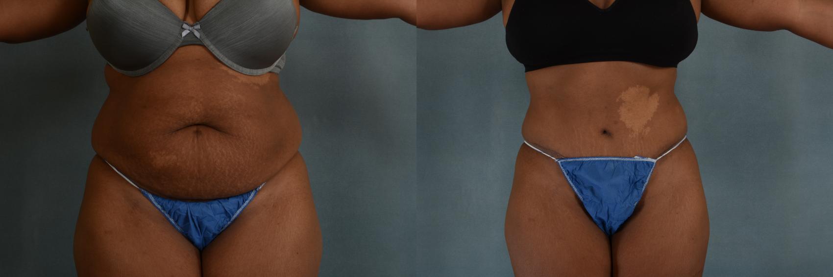 Before & After Tummy Tuck (Abdominoplasty) Case 265 View #1 View in Tallahassee, FL