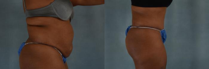 Before & After Tummy Tuck (Abdominoplasty) Case 265 View #2 View in Tallahassee, FL
