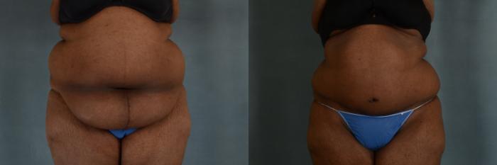 Before & After Tummy Tuck (Abdominoplasty) Case 301 View #1 View in Tallahassee, FL