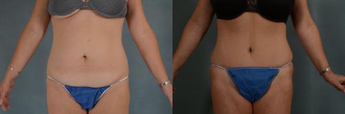 Before & After Tummy Tuck (Abdominoplasty) Case 303 View #1 View in Tallahassee, FL