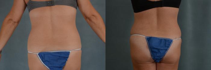 Before & After Tummy Tuck (Abdominoplasty) Case 303 View #3 View in Tallahassee, FL