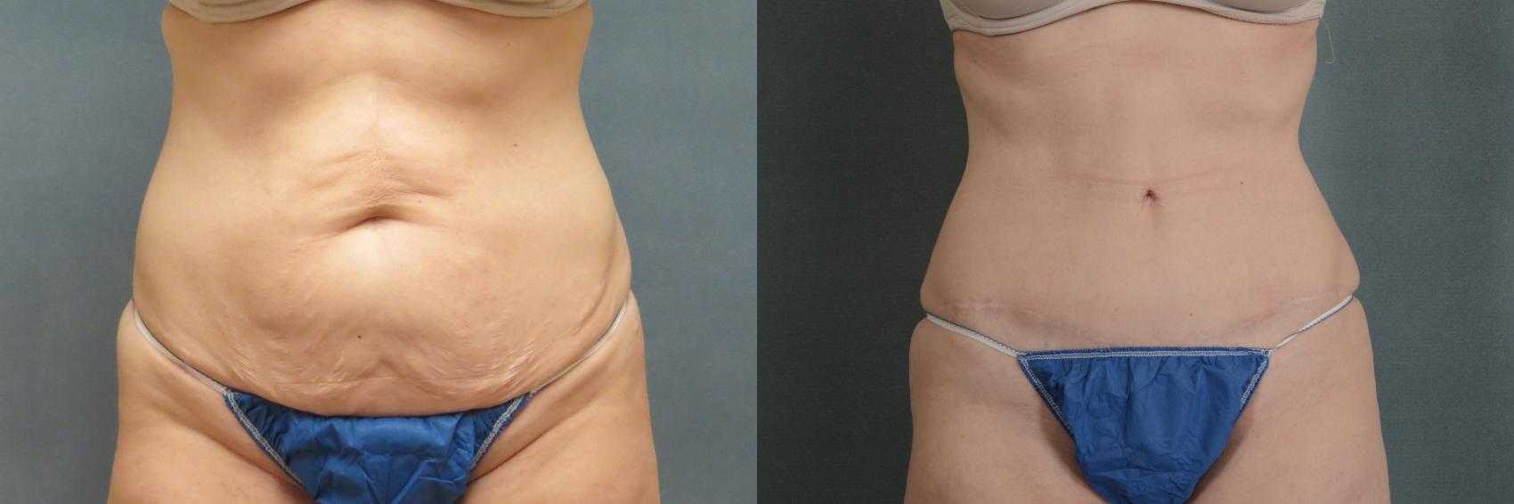 Before & After Tummy Tuck (Abdominoplasty) Case 310 View #1 View in Tallahassee, FL