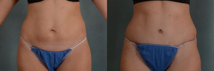 Before & After Tummy Tuck (Abdominoplasty) Case 312 View #1 View in Tallahassee, FL