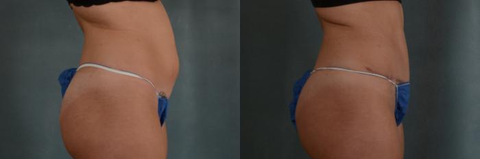 Before & After Tummy Tuck (Abdominoplasty) Case 312 View #2 View in Tallahassee, FL