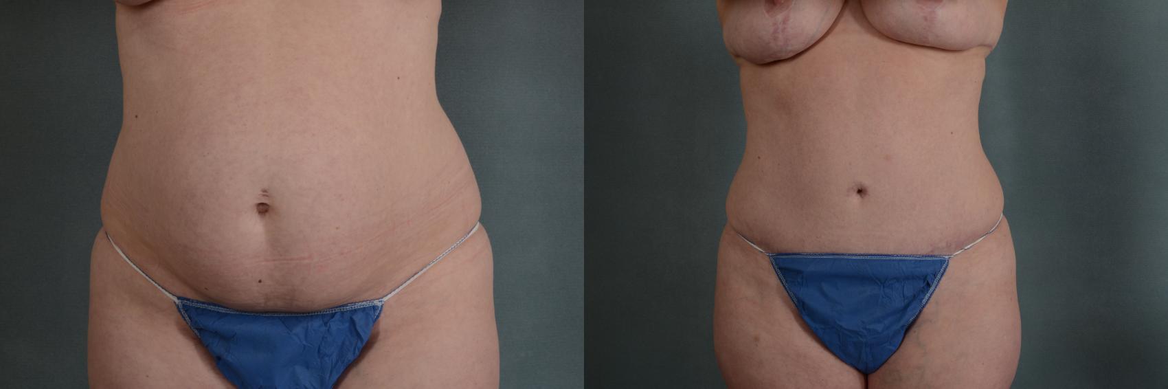 Before & After Tummy Tuck (Abdominoplasty) Case 328 View #1 View in Tallahassee, FL