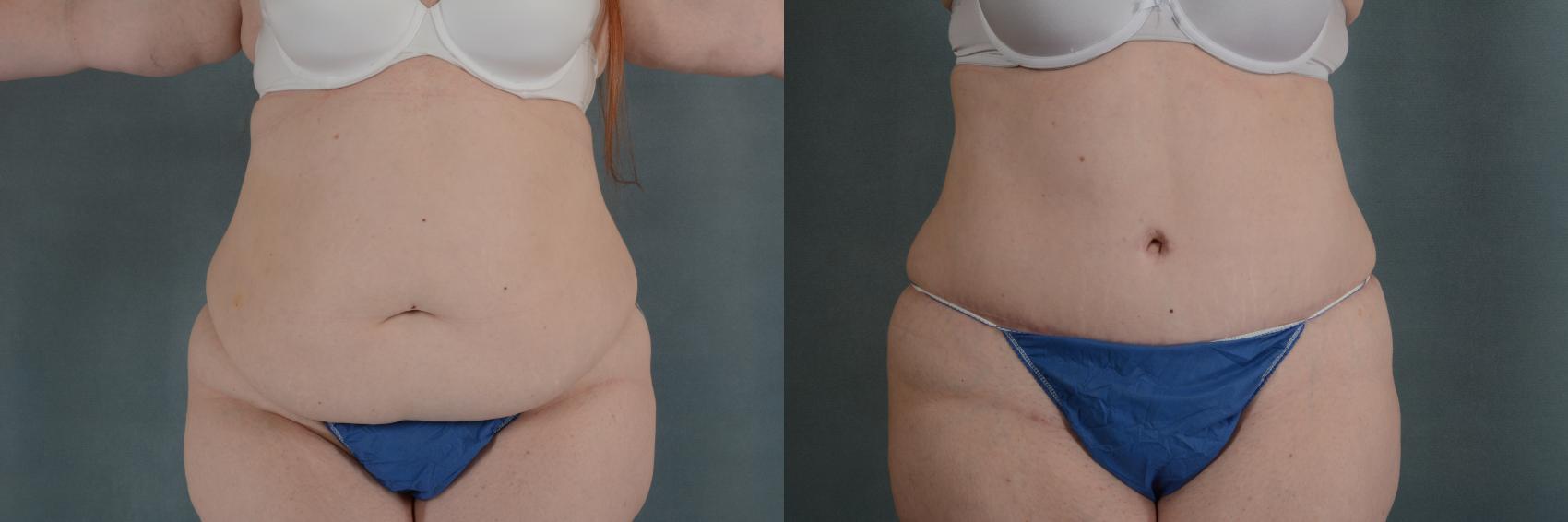 Before & After Tummy Tuck (Abdominoplasty) Case 330 View #1 View in Tallahassee, FL