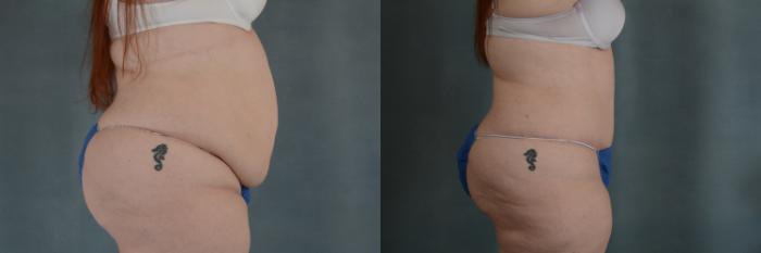 Before & After Tummy Tuck (Abdominoplasty) Case 330 View #2 View in Tallahassee, FL
