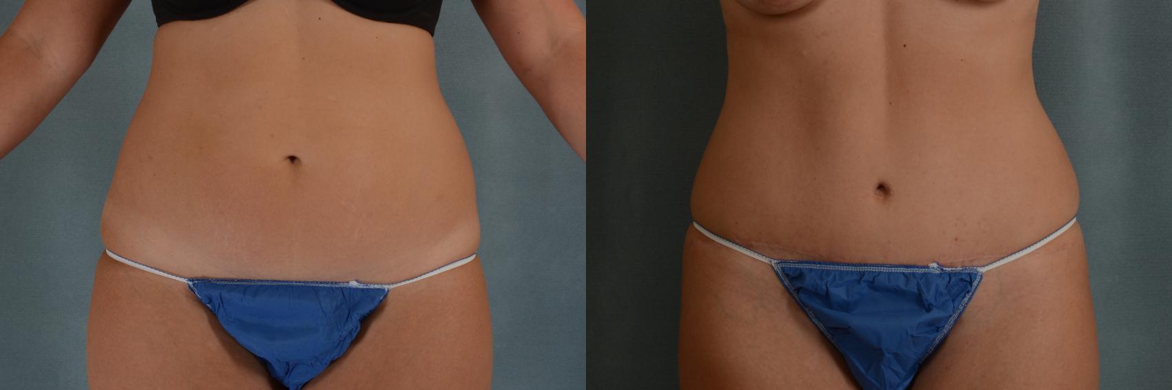Before & After Tummy Tuck (Abdominoplasty) Case 342 View #1 View in Tallahassee, FL