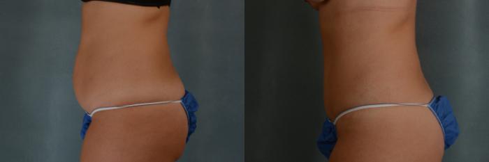 Before & After Tummy Tuck (Abdominoplasty) Case 342 View #2 View in Tallahassee, FL
