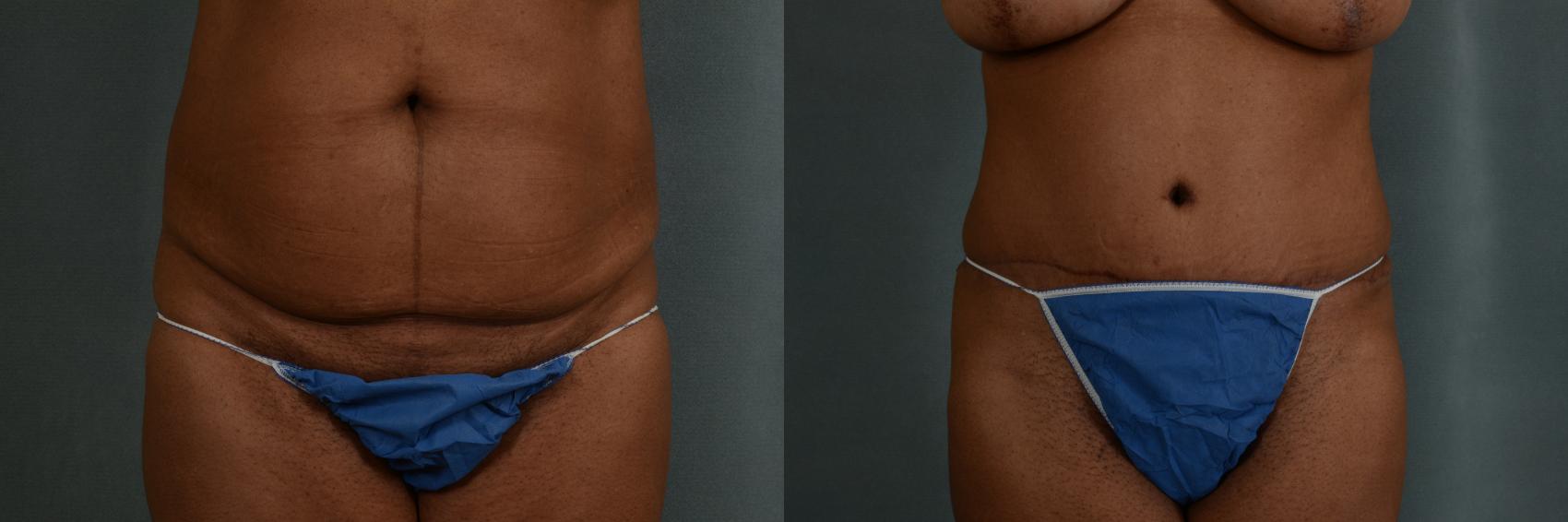 Before & After Tummy Tuck (Abdominoplasty) Case 360 View #1 View in Tallahassee, FL