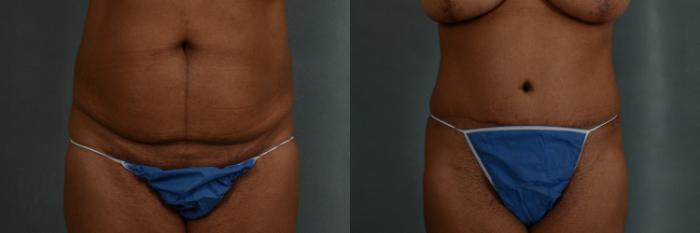 Before & After Tummy Tuck (Abdominoplasty) Case 360 View #1 View in Tallahassee, FL