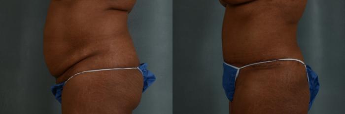 Before & After Tummy Tuck (Abdominoplasty) Case 360 View #2 View in Tallahassee, FL