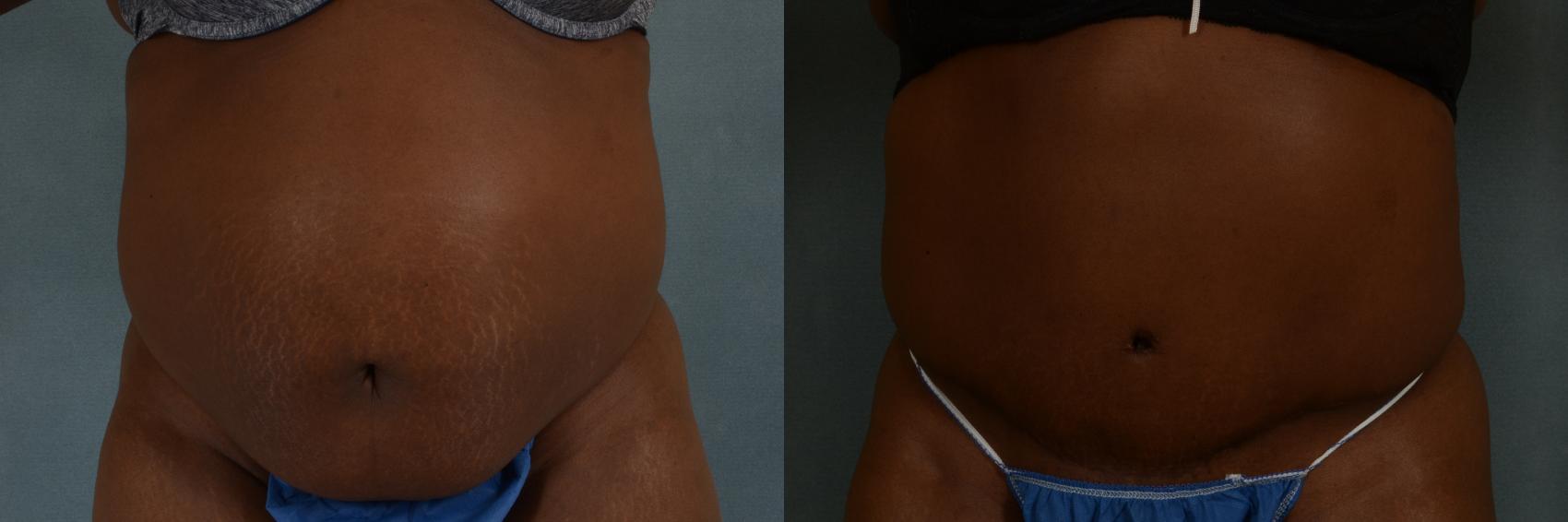 Before & After Tummy Tuck (Abdominoplasty) Case 367 View #1 View in Tallahassee, FL