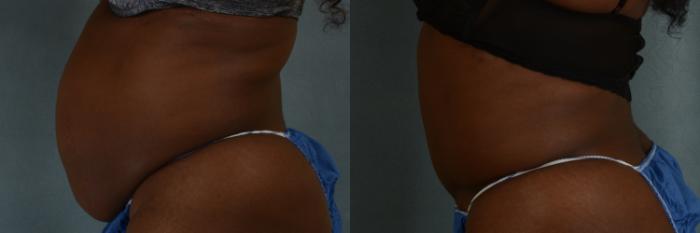 Before & After Tummy Tuck (Abdominoplasty) Case 367 View #2 View in Tallahassee, FL