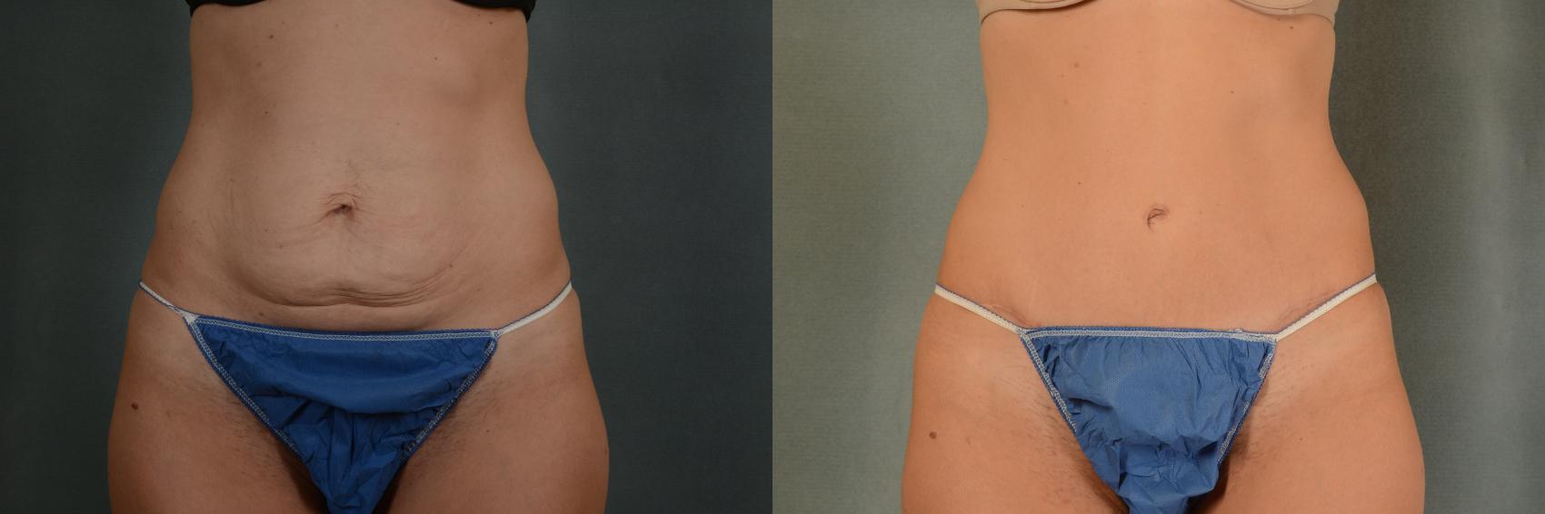 Before & After Tummy Tuck (Abdominoplasty) Case 375 View #1 View in Tallahassee, FL