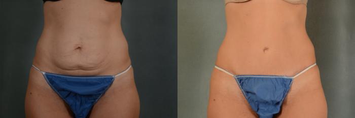 Before & After Tummy Tuck (Abdominoplasty) Case 375 View #1 View in Tallahassee, FL