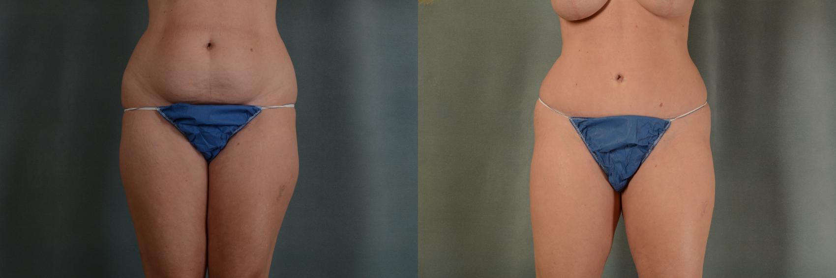 Before & After Tummy Tuck (Abdominoplasty) Case 391 View #1 View in Tallahassee, FL