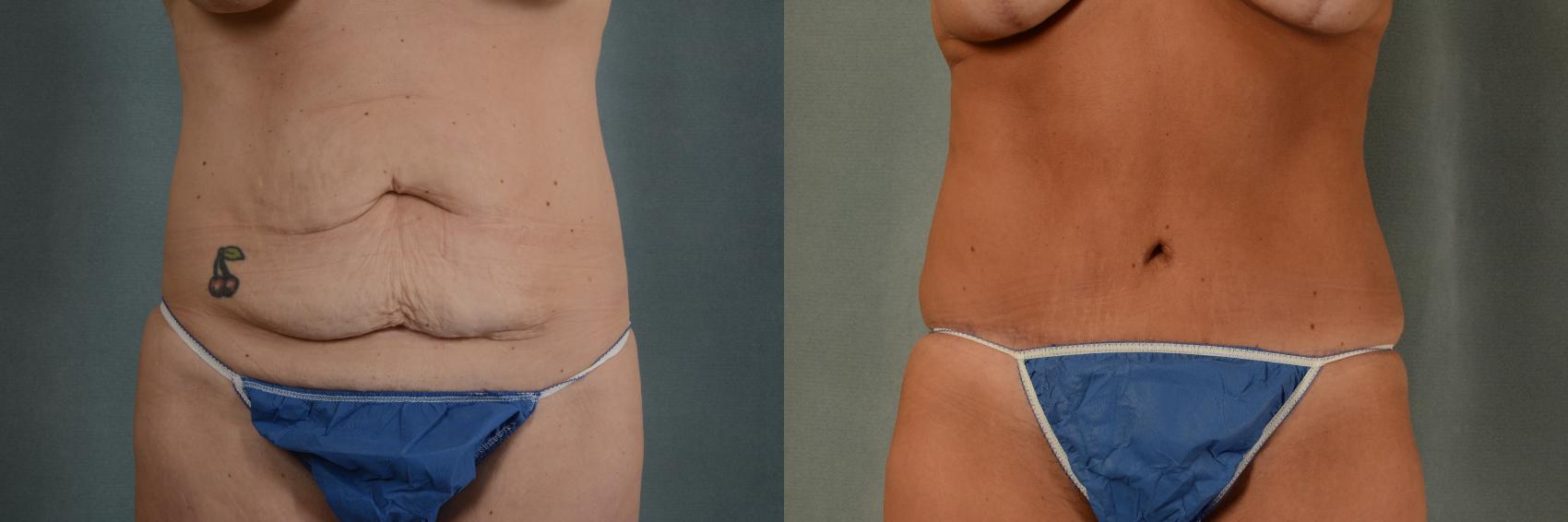 Before & After Tummy Tuck (Abdominoplasty) Case 400 View #1 View in Tallahassee, FL