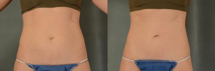 Before & After Tummy Tuck (Abdominoplasty) Case 420 View #1 View in Tallahassee, FL