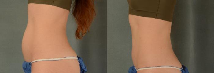 Before & After Tummy Tuck (Abdominoplasty) Case 420 View #2 View in Tallahassee, FL