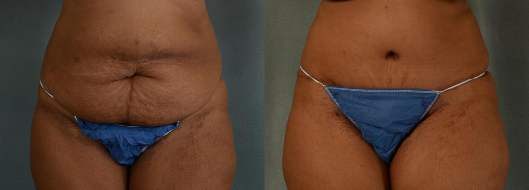 Before & After Tummy Tuck (Abdominoplasty) Case 436 View #1 View in Tallahassee, FL